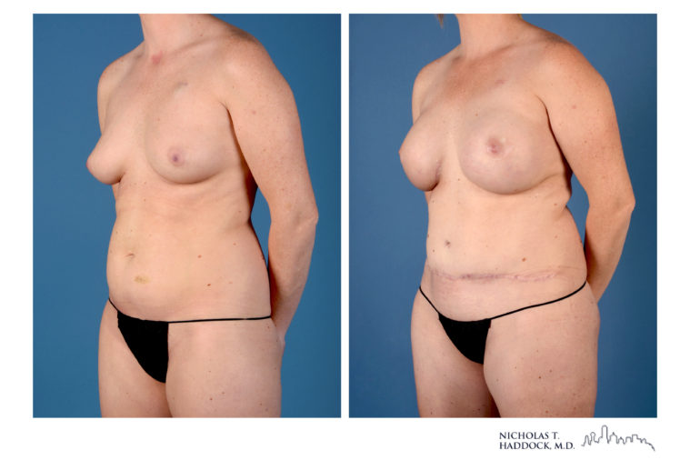 Hybrid DIEP Flap Hybrid DIEP Flap
