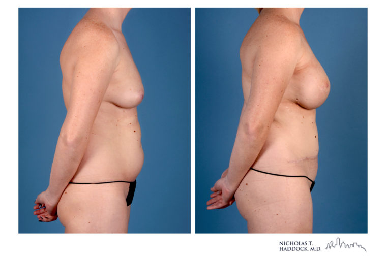 Hybrid DIEP Flap Hybrid DIEP Flap