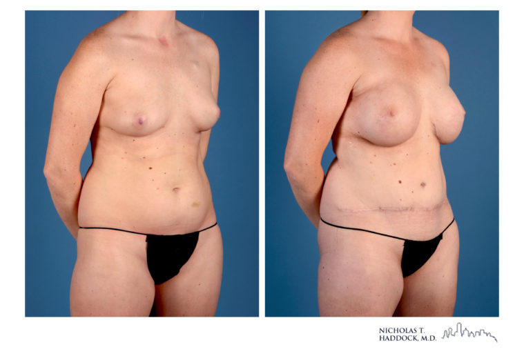 Hybrid DIEP Flap Hybrid DIEP Flap