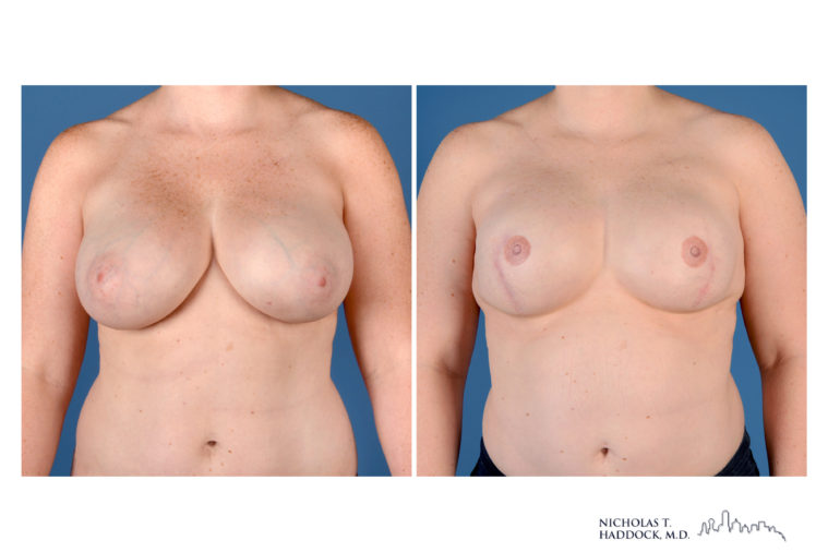 Implant Breast Reconstruction Before and After Photo Implant Breast Reconstruction Before and After Photo