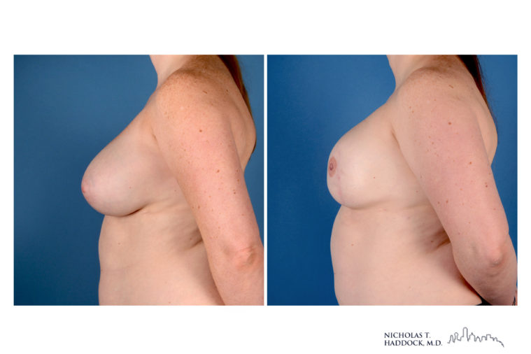 Implant Breast Reconstruction Before and After Photo Implant Breast Reconstruction Before and After Photo