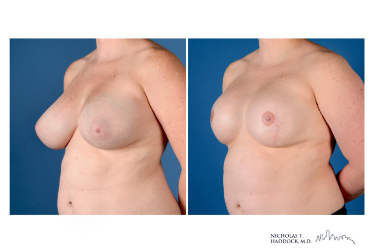 Implant Breast Reconstruction Before and After Photo Implant Breast Reconstruction Before and After Photo