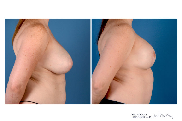 Implant Breast Reconstruction Before and After Photo Implant Breast Reconstruction Before and After Photo