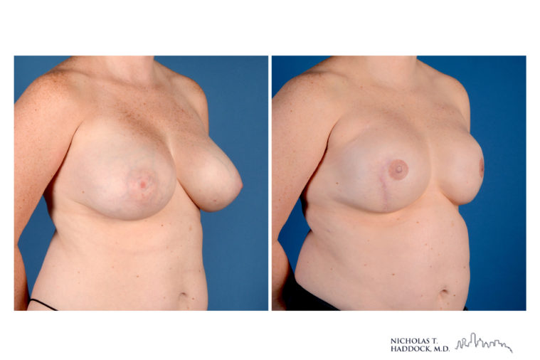 Implant Breast Reconstruction Before and After Photo Implant Breast Reconstruction Before and After Photo