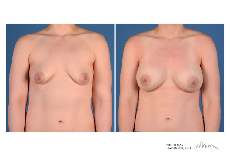 Implant Breast Reconstruction Before and After Photo Implant Breast Reconstruction Before and After Photo