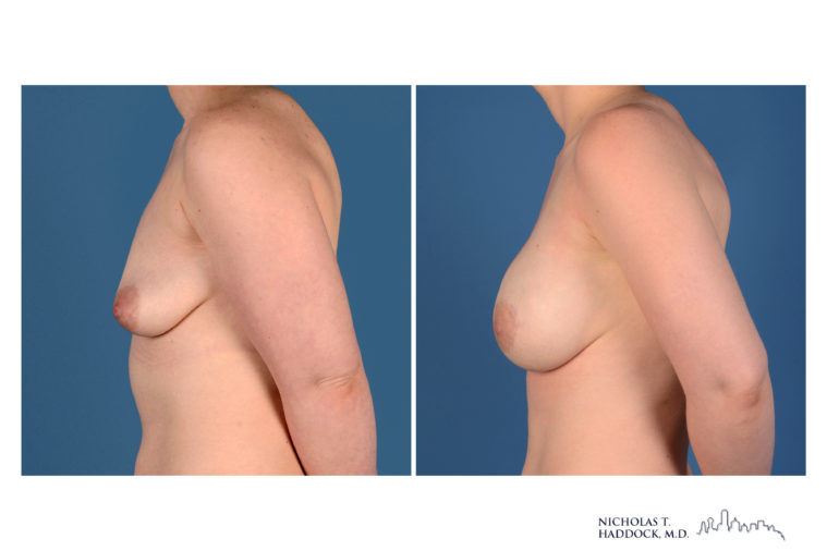Implant Breast Reconstruction Before and After Photo Implant Breast Reconstruction Before and After Photo