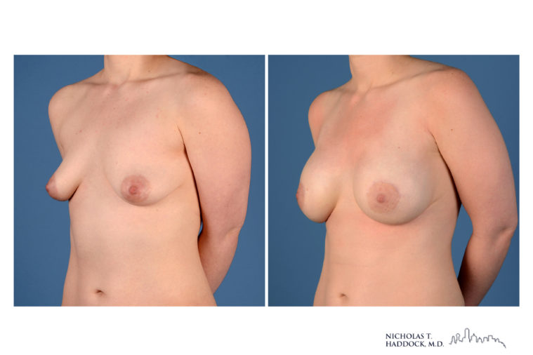 Implant Breast Reconstruction Before and After Photo Implant Breast Reconstruction Before and After Photo