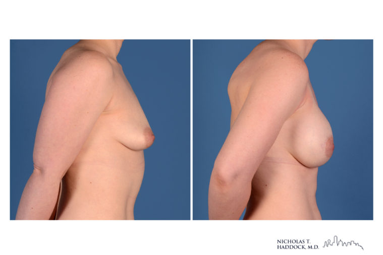 Implant Breast Reconstruction Before and After Photo Implant Breast Reconstruction Before and After Photo