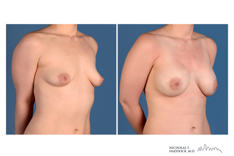 Implant Breast Reconstruction Before and After Photo Implant Breast Reconstruction Before and After Photo