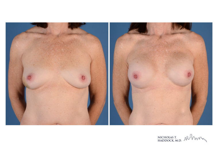 Implant Breast Reconstruction Before and After Photo Implant Breast Reconstruction Before and After Photo