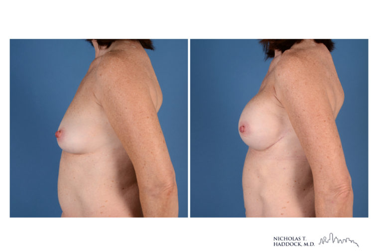 Implant Breast Reconstruction Before and After Photo Implant Breast Reconstruction Before and After Photo