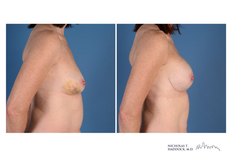 Implant Breast Reconstruction Before and After Photo Implant Breast Reconstruction Before and After Photo