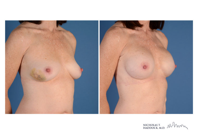 Implant Breast Reconstruction Before and After Photo Implant Breast Reconstruction Before and After Photo
