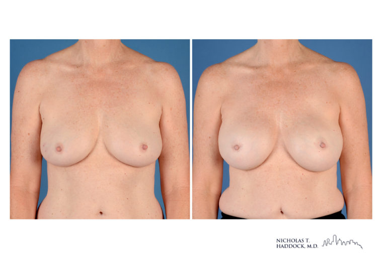 Implant Breast Reconstruction Before and After Photo Implant Breast Reconstruction Before and After Photo