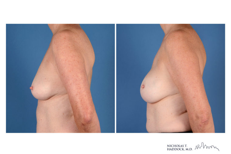 Implant Breast Reconstruction Before and After Photo Implant Breast Reconstruction Before and After Photo