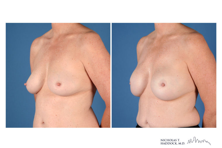 Implant Breast Reconstruction Before and After Photo Implant Breast Reconstruction Before and After Photo