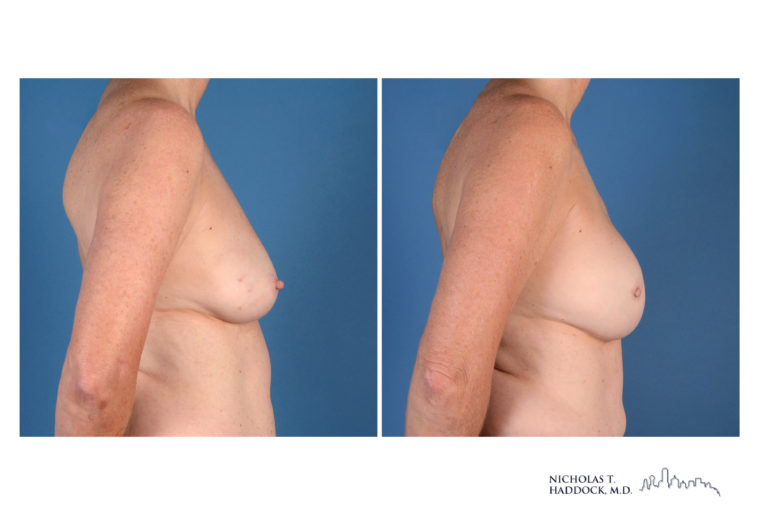 Implant Breast Reconstruction Before and After Photo Implant Breast Reconstruction Before and After Photo