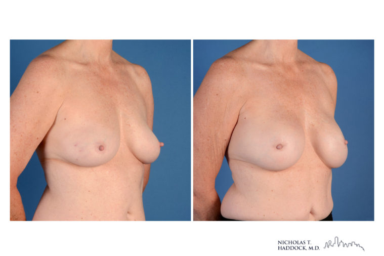 Implant Breast Reconstruction Before and After Photo Implant Breast Reconstruction Before and After Photo