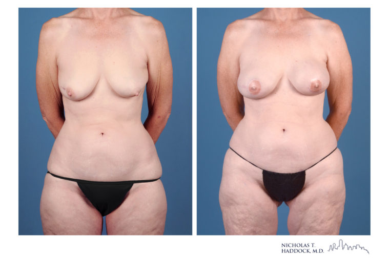 PAP Flap Breast Reconstruction Before and After Photos PAP Flap Breast Reconstruction Before and After Photos