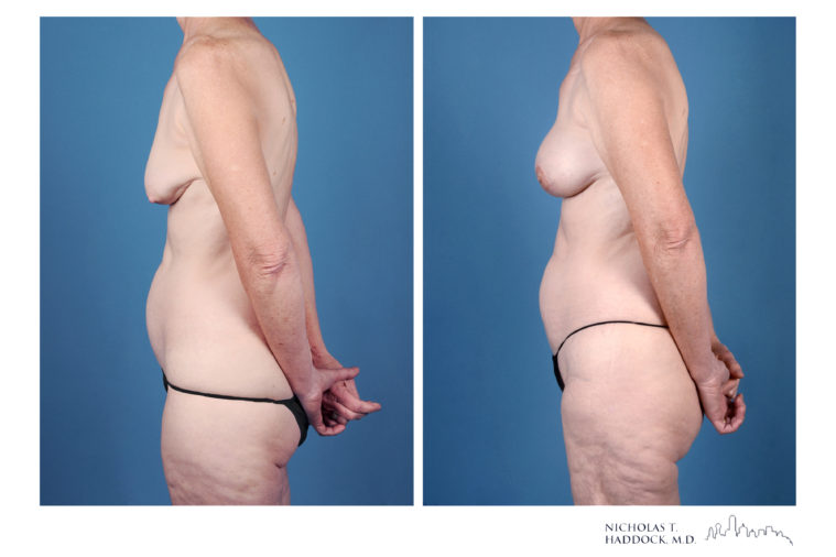 PAP Flap Breast Reconstruction Before and After Photos PAP Flap Breast Reconstruction Before and After Photos