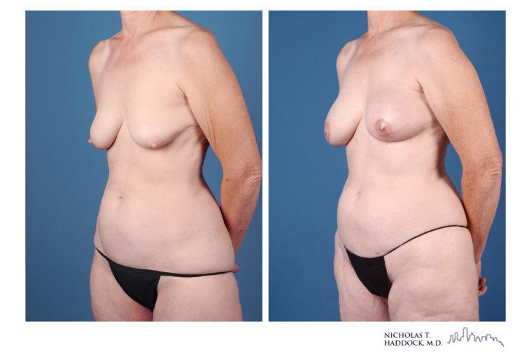 PAP Flap Breast Reconstruction Before and After Photos PAP Flap Breast Reconstruction Before and After Photos