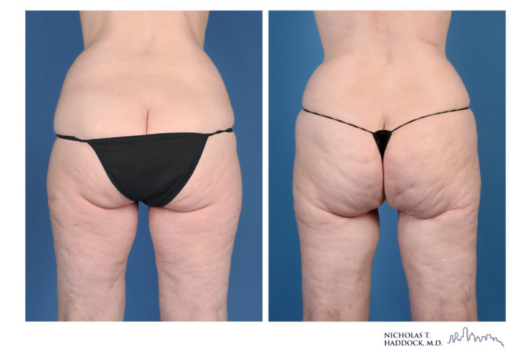PAP Flap Breast Reconstruction Before and After Photos PAP Flap Breast Reconstruction Before and After Photos