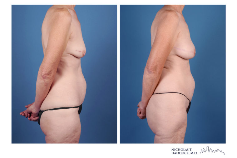 PAP Flap Breast Reconstruction Before and After Photos PAP Flap Breast Reconstruction Before and After Photos