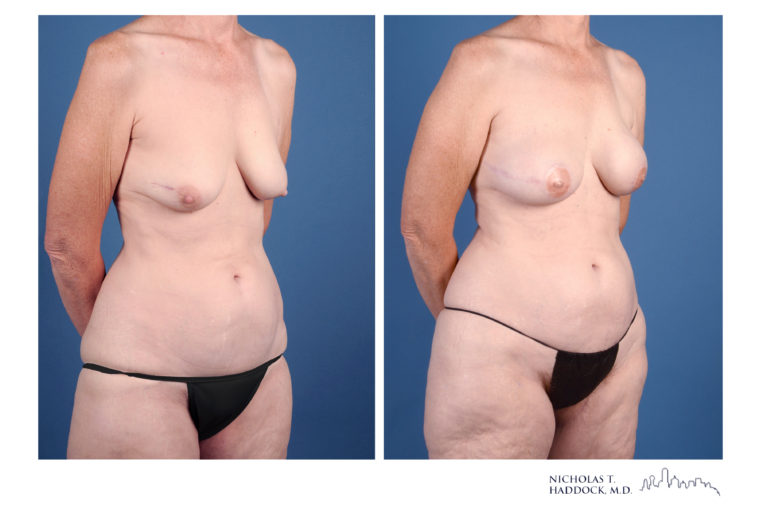 PAP Flap Breast Reconstruction Before and After Photos PAP Flap Breast Reconstruction Before and After Photos