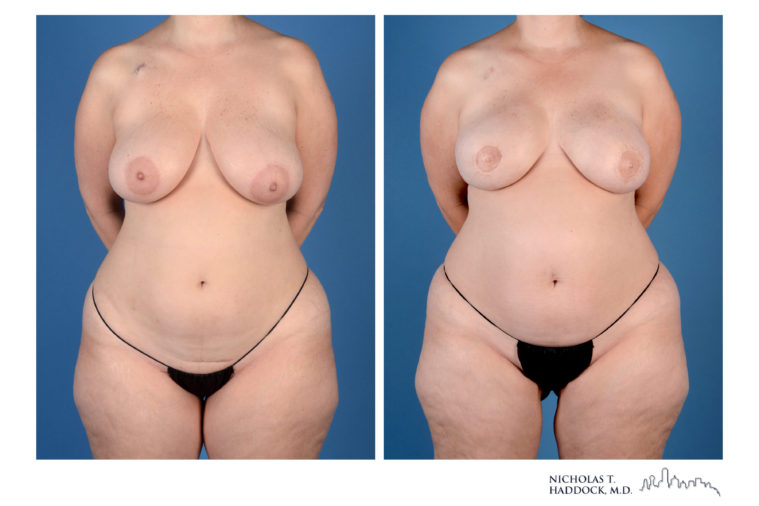 PAP Flap Breast Reconstruction Before and After Photos PAP Flap Breast Reconstruction Before and After Photos