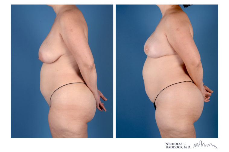 PAP Flap Breast Reconstruction Before and After Photos PAP Flap Breast Reconstruction Before and After Photos