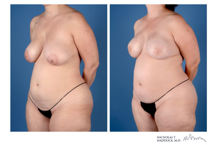 PAP Flap Breast Reconstruction Before and After Photos PAP Flap Breast Reconstruction Before and After Photos