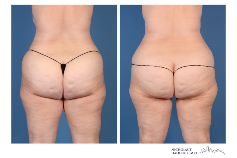 PAP Flap Breast Reconstruction Before and After Photos PAP Flap Breast Reconstruction Before and After Photos