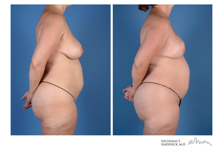 PAP Flap Breast Reconstruction Before and After Photos PAP Flap Breast Reconstruction Before and After Photos