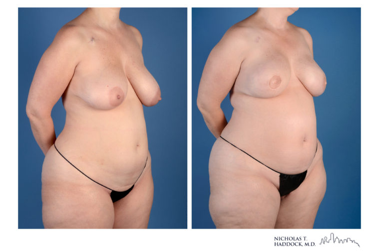 PAP Flap Breast Reconstruction Before and After Photos PAP Flap Breast Reconstruction Before and After Photos