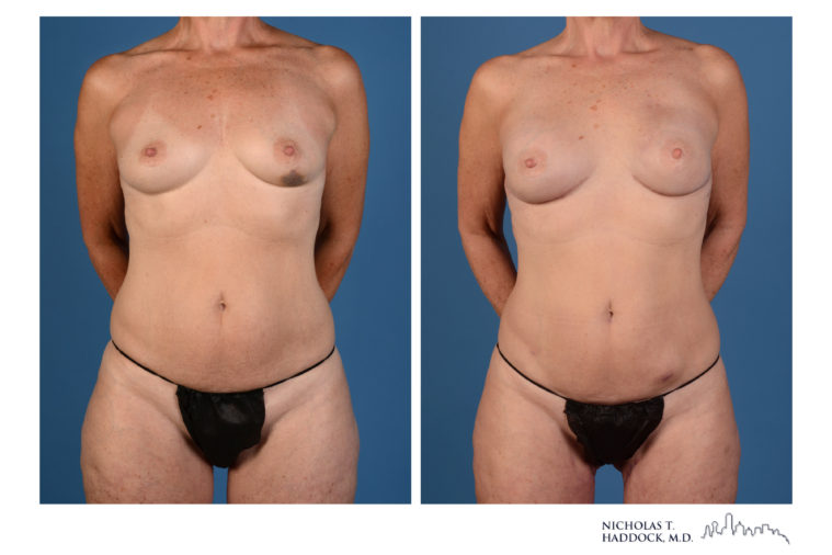 PAP Flap Breast Reconstruction Before and After Photos PAP Flap Breast Reconstruction Before and After Photos