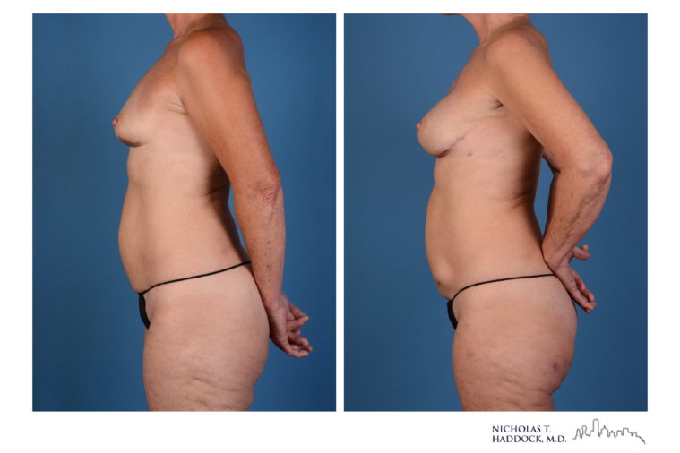 PAP Flap Breast Reconstruction Before and After Photos PAP Flap Breast Reconstruction Before and After Photos