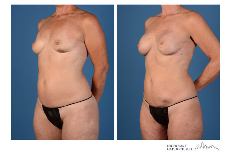 PAP Flap Breast Reconstruction Before and After Photos PAP Flap Breast Reconstruction Before and After Photos