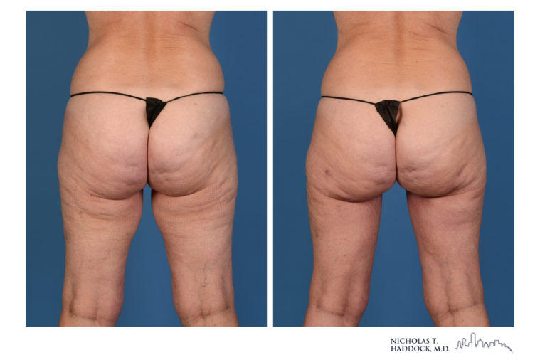 PAP Flap Breast Reconstruction Before and After Photos PAP Flap Breast Reconstruction Before and After Photos