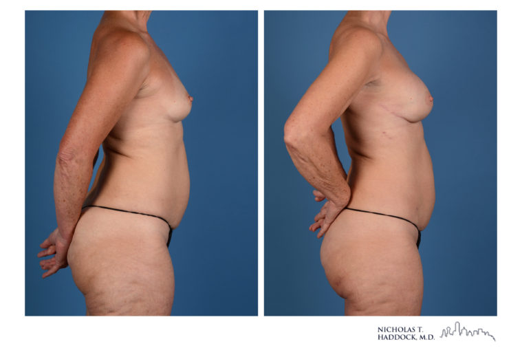 PAP Flap Breast Reconstruction Before and After Photos PAP Flap Breast Reconstruction Before and After Photos