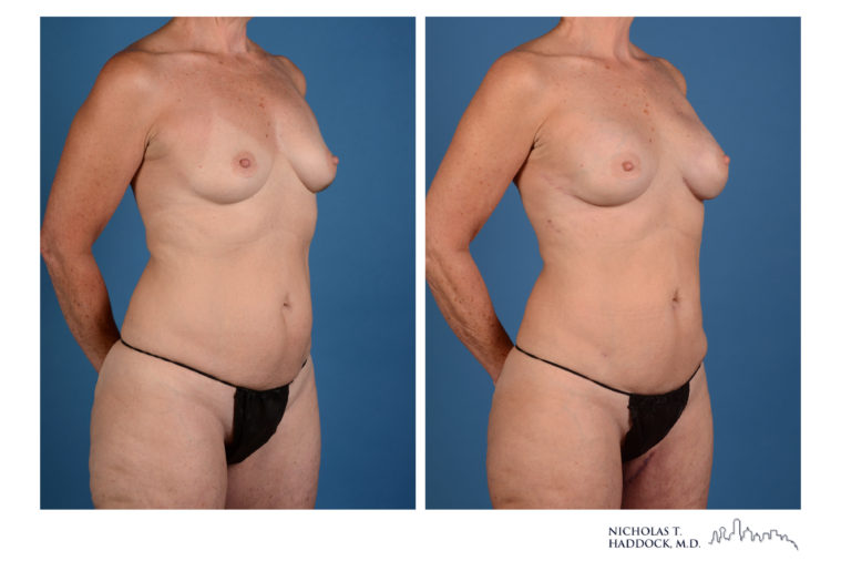 PAP Flap Breast Reconstruction Before and After Photos PAP Flap Breast Reconstruction Before and After Photos