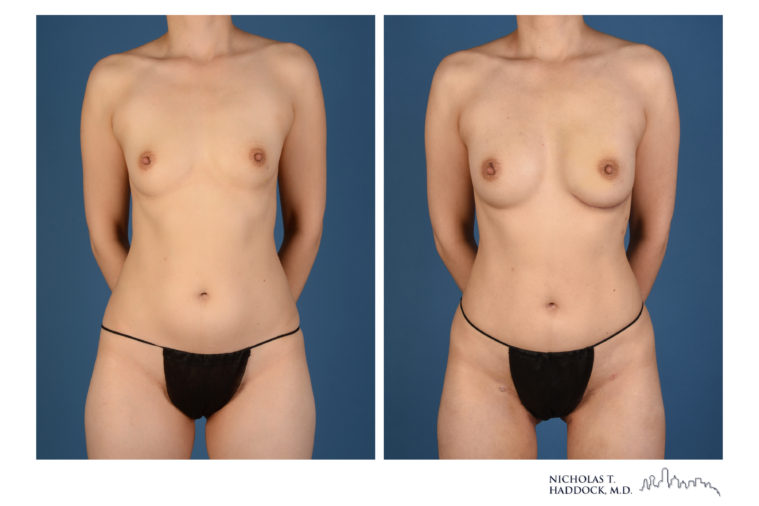 PAP Flap Breast Reconstruction Before and After Photos PAP Flap Breast Reconstruction Before and After Photos
