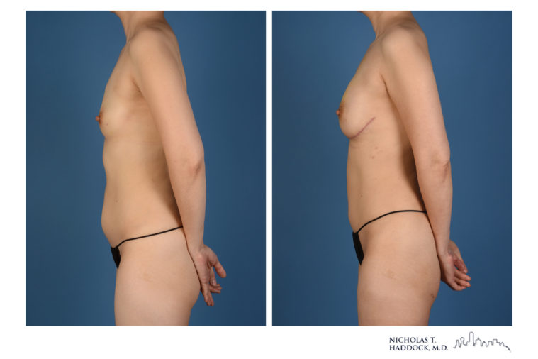 PAP Flap Breast Reconstruction Before and After Photos PAP Flap Breast Reconstruction Before and After Photos