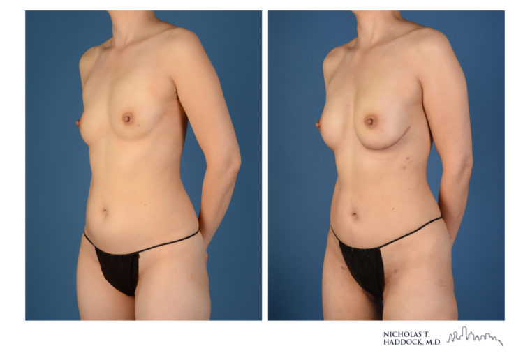 PAP Flap Breast Reconstruction Before and After Photos PAP Flap Breast Reconstruction Before and After Photos