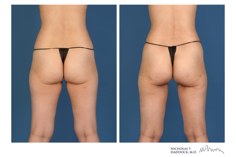 PAP Flap Breast Reconstruction Before and After Photos PAP Flap Breast Reconstruction Before and After Photos