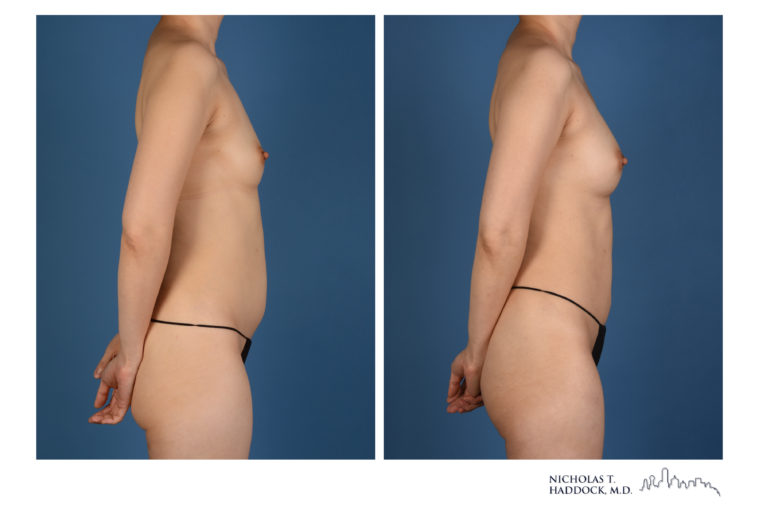 PAP Flap Breast Reconstruction Before and After Photos PAP Flap Breast Reconstruction Before and After Photos