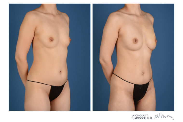 PAP Flap Breast Reconstruction Before and After Photos PAP Flap Breast Reconstruction Before and After Photos