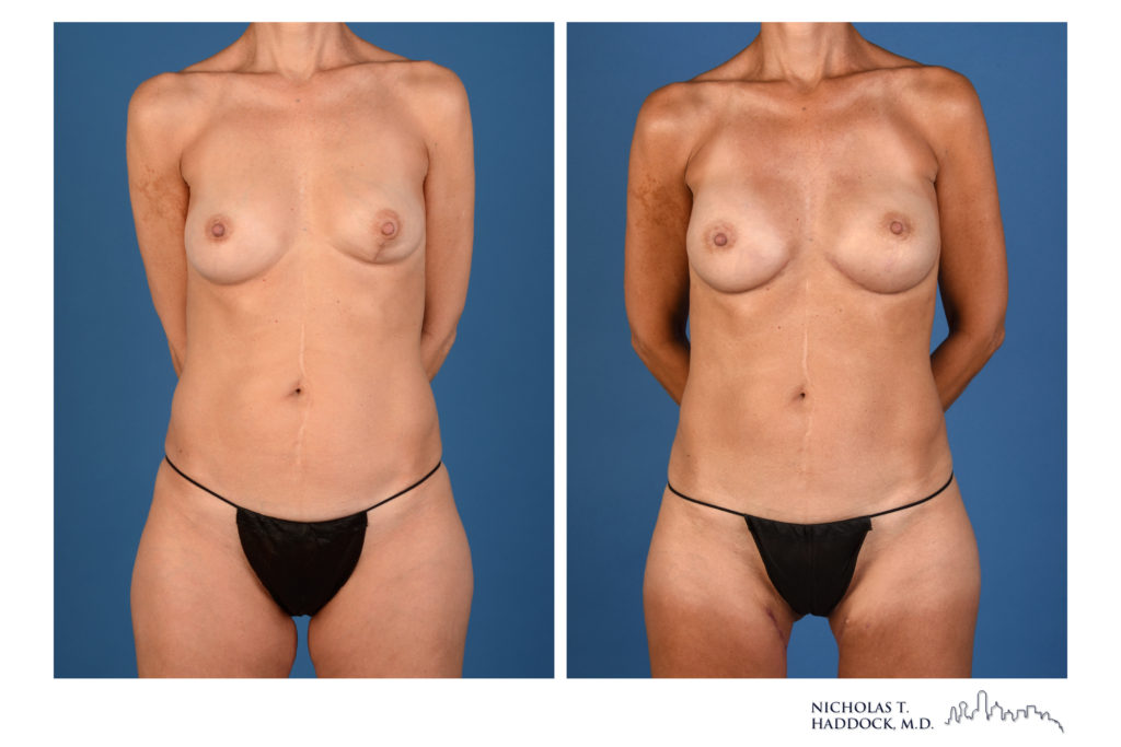 PAP flap breast reconstruction, front view — before on the left, after on the right