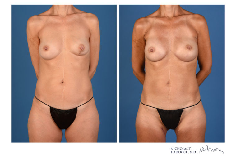 PAP Flap Breast Reconstruction Before and After Photos PAP Flap Breast Reconstruction Before and After Photos