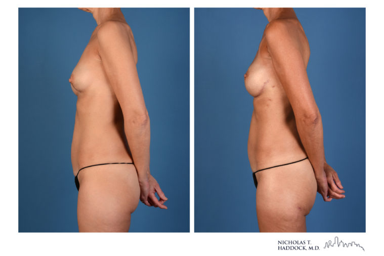 PAP Flap Breast Reconstruction Before and After Photos PAP Flap Breast Reconstruction Before and After Photos