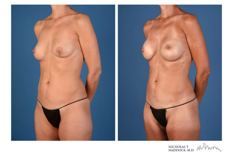 PAP Flap Breast Reconstruction Before and After Photos PAP Flap Breast Reconstruction Before and After Photos
